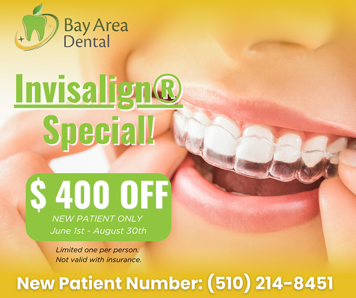 Bay Area Dental | Inlays amp Onlays, Veneers and Invisalign reg